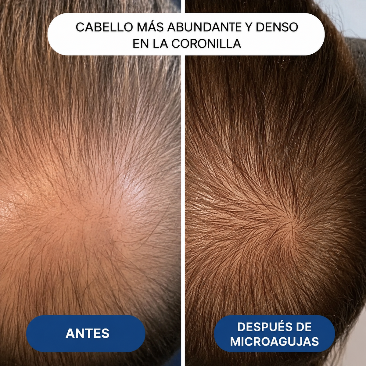 Peptonx® – Sistema de Microinfusión Capilar con Péptidos de Cobre